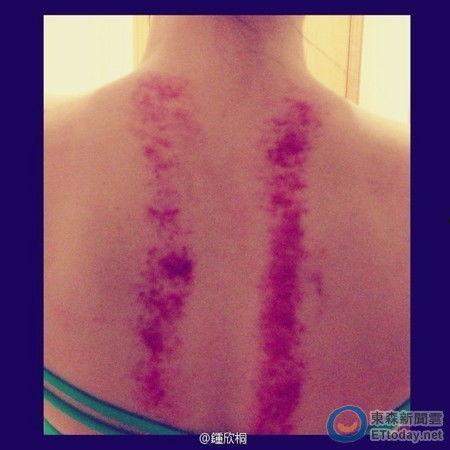 背部刮痧的图片,图解刮痧技巧与功效